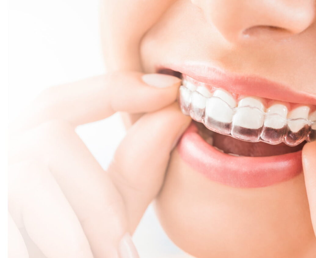 invisalign-clear aligners