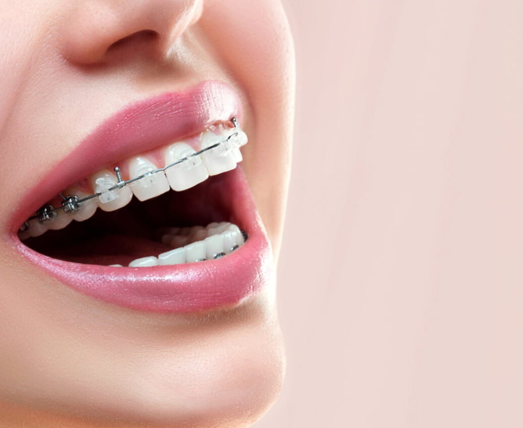 invisalign-braces