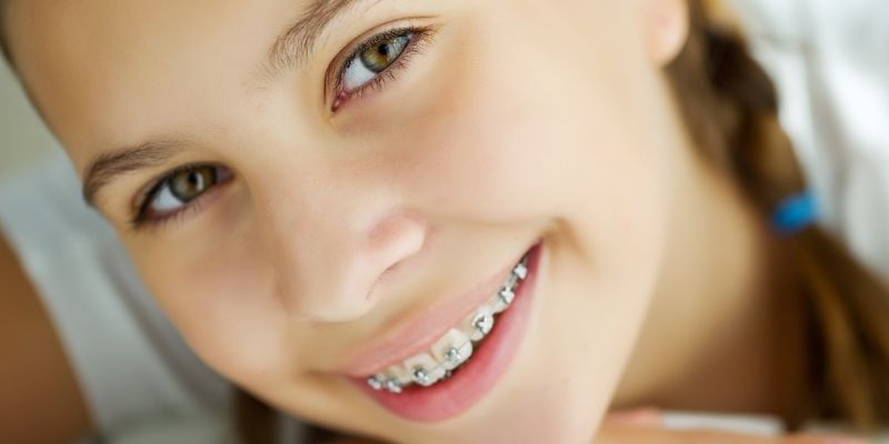 Fixed Braces