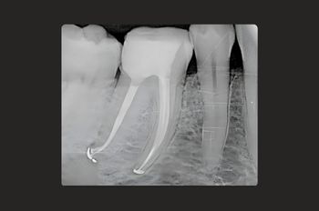 Case 1_After Root Canal