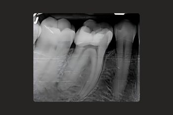 Case 1_Before Root Canal