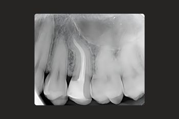 Case 3_After Root Canal