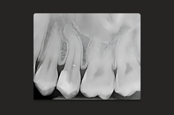 Case 3_Before Root Canal