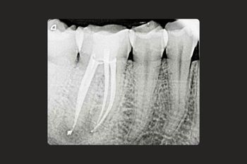 Case 6 After Root Canal
