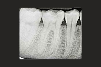 Case 6 Before Root Canal