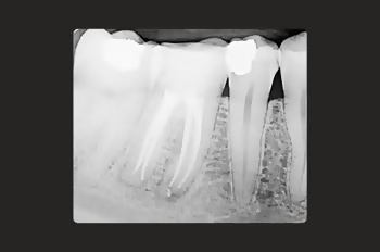 Case 11 After Root Canal