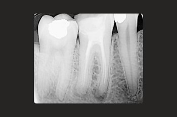 Case 11 Before Root Canal