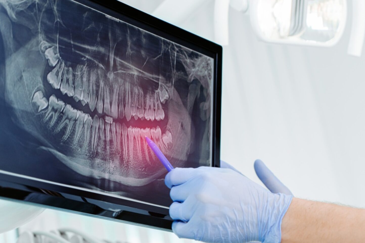 understanding dental xrays