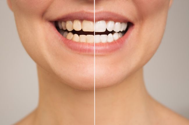 Blog -Moltons Dental